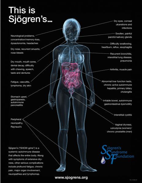 Dental Decay, Sjogrens Syndrome, Gastrointestinal System, Autoimmune Disorder, Dry Eyes, Chronic Fatigue, The Human Body, Autoimmune Disease, Migraine