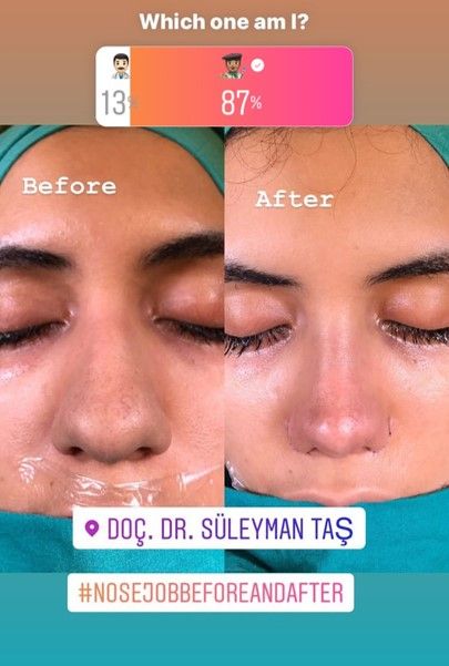 Thick Skin Bulbous Tip Rhinoplasty | Assoc. Prof. Dr. Suleyman TAS Rhinoplasty Bulbous Nose, Bulbous Nose Job Before And After, Thick Skin Bulbous Tip Rhinoplasty, Nose Job Thick Skin, Thick Nose Rhinoplasty, Thick Skin Nose Job, Rhinoplasty Before And After Bulbous, Nose Job Before And After Bulbous, Thick Skin Rhinoplasty