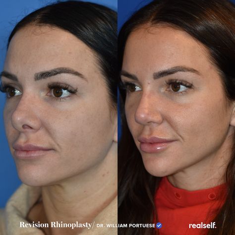 Revision rhinoplasty is a surgical procedure that addresses complications or undesired results following an initial nose job. Revision Rhinoplasty Before After, Thick Skin Rhinoplasty, Revision Rhinoplasty, Ethnic Rhinoplasty, Rhinoplasty Before And After, Rhinoplasty Surgery, Facial Fillers, Thick Skin, Nose Job