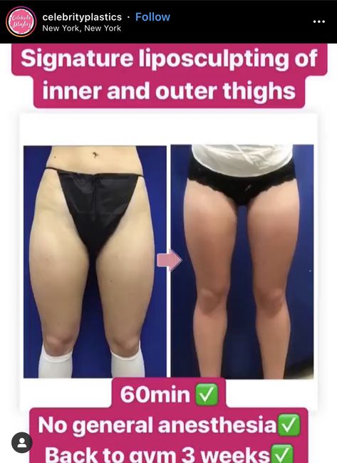 lipo on legs Thigh Lipo Before And After, Lipo Before And After, General Anaesthesia, Laser Lipo, Fitness Goals, Beauty