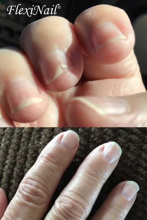 This is a picture of Linda Himmel's nails before and after using FlexiNail. How To Repair Split Nails, Metaboosting Diet, Split Nail Repair, Flaky Nails, Fingernail Health, Split Nails, Peeling Nails, Nail Repair, Nail Pictures