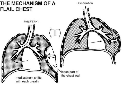 Flail Chest, Thoracic Cage, Physician Assistant Student, Arterial Blood Gas, Pre Med Student, Mechanical Ventilation, Critical Care Nursing, Respiratory Therapy, Muscle Weakness