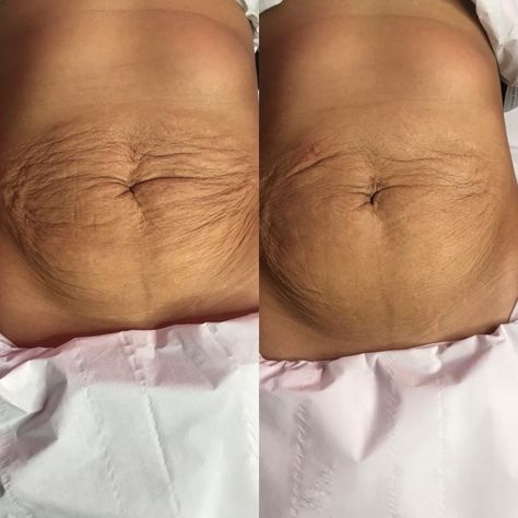 Non-Surgical Body Contouring & Sculpting!!! Are you interested in contouring your body the non-surgical way, then this is for you. Helping with both skin tightening and body contouring for many different areas of your body. Based in Wembley (North West London) www.contourandglow.co.uk Email: info@contourandglow.co.uk Change Appearance, Radio Frequency Skin Tightening, Skin Tightening Treatments, Cardboard Letters, Body Contour, Stubborn Fat, Beauty Studio, Real Results, Radio Frequency