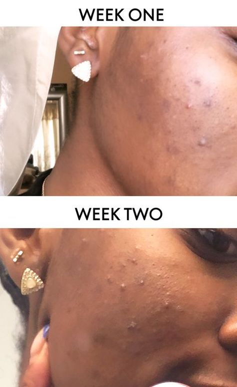 I Tired Skin Fasting For Two Weeks and I’ll Probably Never Do It Again - Does Skin Fasting Work? Skin Fasting, Break A Habit, Healing Clay, Cleanse Me, Pca Skin, Do It Again, Daily Skin Care Routine, Perfect Skin, Deep Cleansing