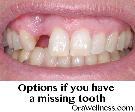 If you are missing teeth or even a single missing tooth, you have several options to restore your precious smile. FREE guidebook here. Natural Teeth Whitening Remedies, Fix Teeth, Chipped Tooth, Temporary Tooth, Missing Tooth, Tooth Repair, Teeth Whitening Remedies, Teeth Whitening Diy, Bad Teeth