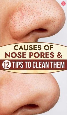 How To Close Pores, Clean Nose Pores, Eye Health Remedies, Big Pores, Nose Pores, Natural Face Skin Care, Enlarged Pores, Best Moisturizer, Unclog Pores