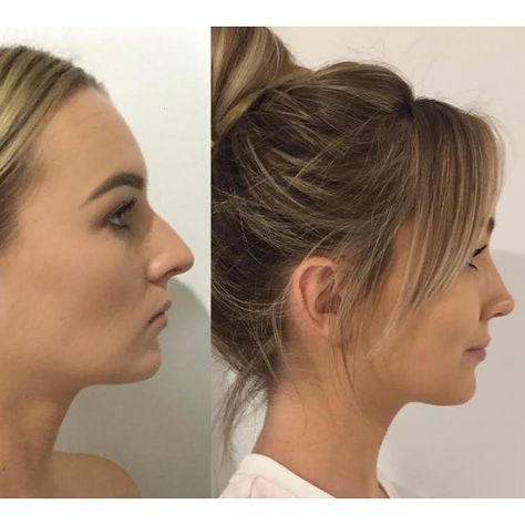 453 Likes, 42 Comments - CosMediTour (@cosmeditour) on Instagram: “Incredible Breast Augmentation before and after!  Our Gold Coast Plastic Surgeons achieved this…” Nose Job, Long Hair With Bangs, Haircut And Color, Brown Blonde Hair, After Photos, Grunge Hair, Hairstyles With Bangs, Up Hairstyles, Pretty Hairstyles