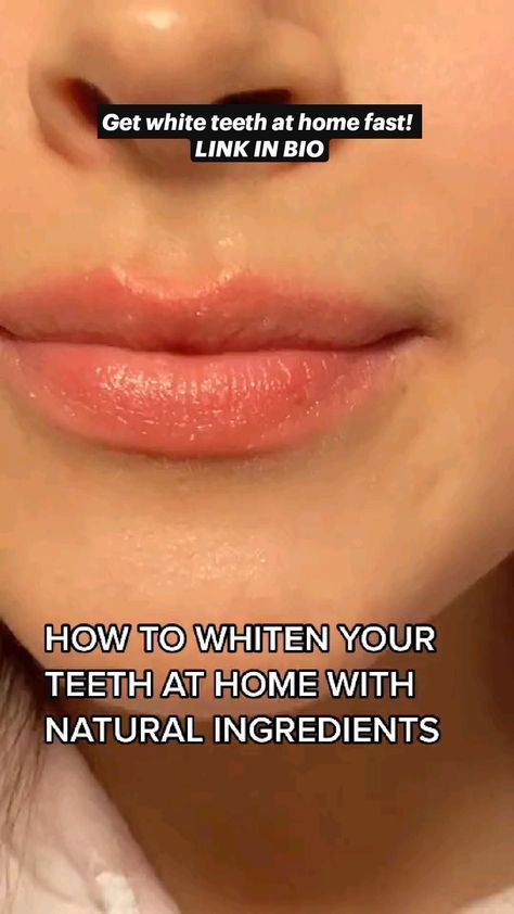 Get white teeth at home fast!  LINK IN BIO V34 Colour Corrector, Colour Corrector, Get Whiter Teeth, Whitening Teeth, Dental Cavities, Whiten Your Teeth, Teeth Whitening System, Grills Teeth, Yellow Teeth