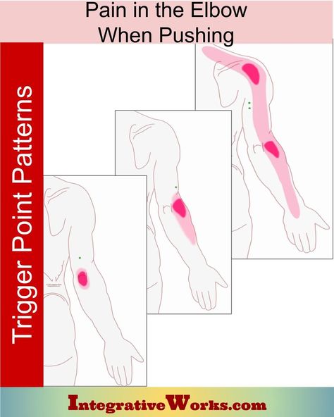 Elbow Pain When Pushing - How people describe this pain, what causes or intensifies the pain, links to anatomy, self-care, and therapist notes. Integrative Works Shoulder Trigger Points, Torn Labrum, Neuromuscular Therapy, Radial Nerve, Elbow Pain, Tension Relief, Upper Back Pain, Trigger Point, Mind Body Connection