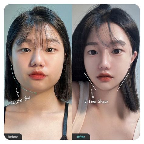 #plasticsurgery #plasticsurgerygonewrong #beforeafter #celebritiesbeforeafter #hollywoodstars #bignosesurgery #surgery #facesurgery #vlinesurgery #koreanplasticsurgery #kpopplasticsurgery #nosejob #jawreductionsurgery #eyesurgery #cheekfillers #rhinoplasty #facelift #plasticsurgeryfails #expensiveplasticsurgery #viral V Shaped Jaw, Kpop Plastic Surgery, Jaw Reduction Surgery, V Line Surgery, V Line Face, Plastic Surgery Fail, V Shape Face, Korean Plastic Surgery, Plastic Surgery Gone Wrong