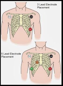 EKG Lead Placement Ekg Lead Placement, 12 Lead Ekg Placement, Ekg Placement, Lead Placement, Ekg Leads, Work Humour, Nursing Knowledge, Ecg Interpretation, Nclex Pn