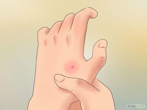 How to Treat Spider Bites via wikiHow.com Spider Bites Remedies, Different Bug Bites, Treating Spider Bites, Spider Bite Symptoms, Spider Bites Pictures, Spider Identification, Dangerous Spiders, Home Remedies For Spiders, Spider Bite