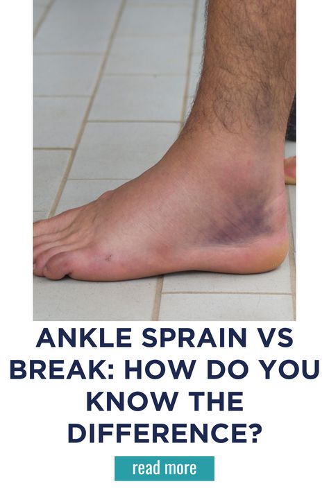 Sprained Ankle Quotes, Sprain Ankle Remedies, How To Break Your Ankle, Ankle Exercises After Sprain, Healing A Sprained Ankle Fast, How To Wrap An Ankle, Sprained Ankle Snapchat, Sprained Ankle Remedies, Broken Ankle Cast