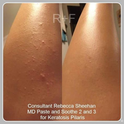 Check out this before and after for Keratosis Pilaris by Rebecca.  If you struggle from this issue, let's get you started seeing results too!  Message me at GracesRodanAndFields@gmail.com        #KeratosisPilaris #RodanAndFields #Exfoliation #Results #LifeChangingSkincare Skin Lightening Lotion, Microdermabrasion Paste, Dry Skin Makeup, Lightening Serum, Skin Lightener, Skin Bumps, Dry Skin Remedies, Keratosis Pilaris, Chicken Skin