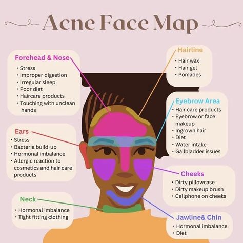 Acne Face Map: Causes for Clear Skin ⬇️⬇️⬇️ Discover the secret language of your skin with the acne face map! This connects specific areas of your face to underlying causes of acne. In this post, we'll explore the face map, uncovering key regions and preventive acne methods. The mysteries of acne with the face map. From hormonal imbalances on the forehead to hygiene habits affecting the cheeks, each area tells a unique story. Excess oil production in the T-zone? We'll show you how to balan... Acne Face Map, Hormonal Imbalance Diet, Cheek Acne, Face Map, Hair Diet, Causes Of Acne, Different Types Of Acne, Face Mapping Acne, Acne Diet