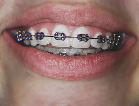 Purple Braces Aesthetic, Dark Purple Braces, Lavender Braces, Purple Braces, Braces Bands, Teeth Aesthetic, Cute Braces Colors, Adult Braces, Braces Tips