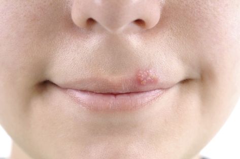 Preventing cold sores - Harvard Health Fever Blister Causes, Fever Blister Remedy, Cold Sore Prevention, Home Remedies For Fever, Lips Care, Fever Blister, Canker Sore, Cold Sores Remedies, How To Get Rid Of Pimples