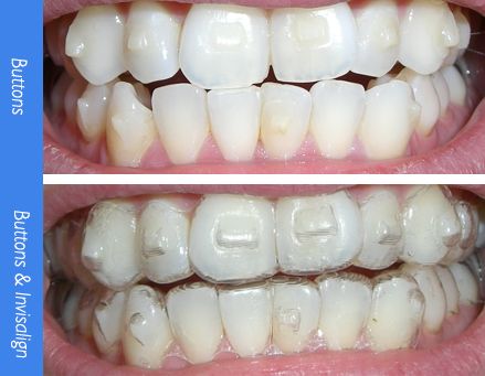 invisalign buttons Invisalign Tips And Tricks, Invisalign Before And After, Invisalign Aesthetic, Invisalign Attachments, Invisalign Hacks, Invisalign Tips, Smile Tips, Mouth Care, Invisalign Aligners