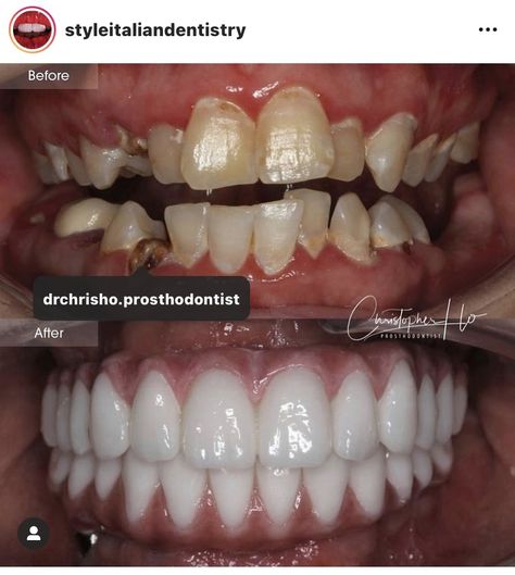 Porcelain Veneers before and after by styleitaliandentristry . Porcelain Veneers Before And After, Veneers Before And After, Teeth Makeover, Teeth Veneers, Tooth Care, Veneers Teeth, Dental Work, Porcelain Veneers, Makeover Before And After