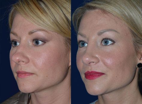 Rhinoplasty Bulbous Tip, Bulbous Nose Rhinoplasty Before After, Bulbous Tip Rhinoplasty, Bulbous Nose Rhinoplasty, Tip Rhinoplasty, Nose Rhinoplasty, Nose Plastic Surgery, Rhinoplasty Recovery, Lipo Before And After