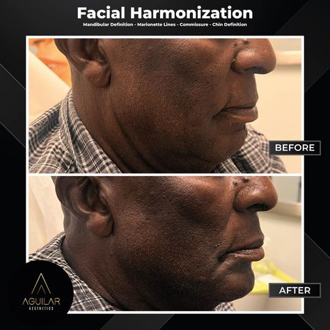 Enhance your natural beauty with facial harmonization. ✨ Facial harmonization offers a series of benefits, such as: Improves facial symmetry. Reduces wrinkles and expression lines. Restores lost facial volume. Defines and highlights facial features. Provides a more rejuvenated and fresh appearance. Corrects facial asymmetries. Increases confidence and self-esteem. Natural and long-lasting results. 🌟Interested in this procedure? Book a free appointment with us today! ✨ Aguilar Aesthetics & ... Aesthetic Injector, Facial Symmetry, Glow Aesthetic, Skin Laser, Vampire Facial, Laser Resurfacing, Iv Drip, Increase Confidence, Hollywood Beach