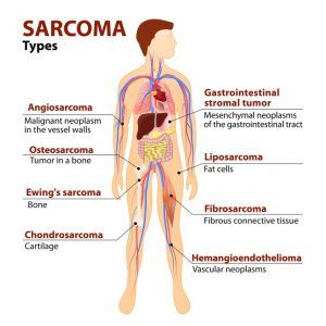 Sarcoma Awareness Month, Sarcoma Awareness, Types Of Cancers, Headache, Anatomy, The Globe, Human Body, Human