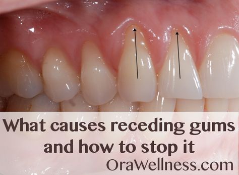 Holistic answers to the questions about receding gums. Grow Back Receding Gums, Gum Recession, Teeth Whitening Remedies, Teeth Health, Stronger Teeth, Gum Care, Receding Gums, Oil Pulling, Gum Health