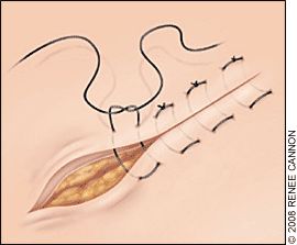 Horizontal mattress suture technique. Suture Techniques, Pa School, Vet School, French Vocabulary, School Notes, Vocabulary, Mattress, Quick Saves