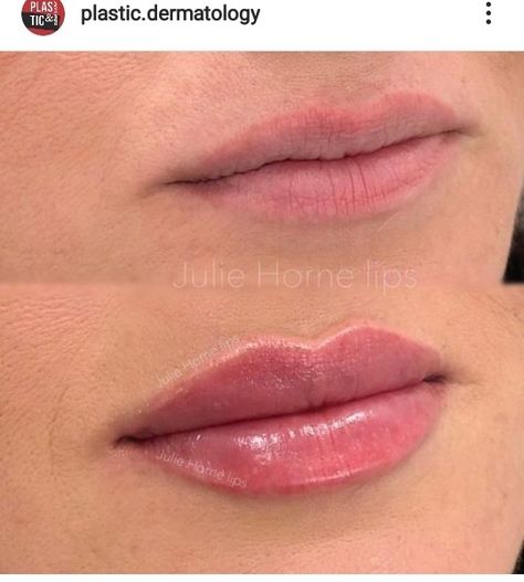 Kysse Lips Filler Before And After, Small Lip Fillers Before And After, Lip Fillers Before And After, Subtle Lip Filler Before And After, 0.5 Ml Lip Filler Before And After, Lip Filler Shape Ideas, Natural Lip Fillers, Lip Filler Before And After, Lip Color Tattoo