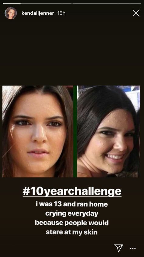 Kendall Jenner Acne, Kendall Jenner Skin, Kendall Ve Kylie, Style Kendall Jenner, Kendall Jenner Face, Jenner Hair, Kendall Jenner Makeup, Instagram Vs Real Life, Jenner Makeup