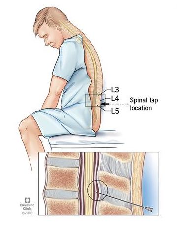 Spinal Tap, Spinal Fluid, Throbbing Headache, Cerebrospinal Fluid, Severe Headache, Cleveland Clinic, Headache Relief, Skin Pores, Spinal Cord