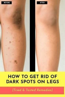 Concerned about spots on legs? Spots or darker patches may often be the result of melanin (what gives your skin its color) concentrating in one area. Finding the root cause of dark/black spots on the legs is key to choosing the right treatment. Here you are on the right platform to find the causes and natural treatments to remove spots on your legs with natural ingredients. Leg Scars, Dark Spots On Legs, Spots On Legs, Dark Spots On Face, Smooth Legs, Dark Spots On Skin, Skin Spots, Spots On Face, Beauty Tips For Glowing Skin