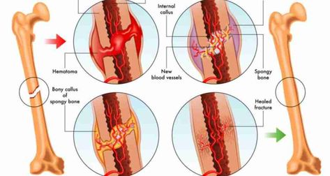 Crystals for Bone Healing - Heal with Crystal Broken Ankle Recovery, Fracture Healing, Bone Healing, Bone Grafting, Bone Fracture, Medical Photos, Human Body Anatomy, Aging Population, Bone Loss