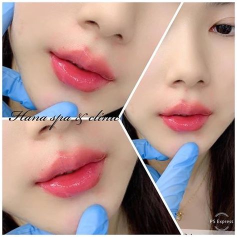 Lip Filler Shape Ideas Korean, Korean Cherry Lips Filler, Korean Lip Filler, Ideal Lips, Lip Ideas, Nose Fillers, Txt Magic, Korean Fashion Kpop Inspired Outfits, Korean Lips