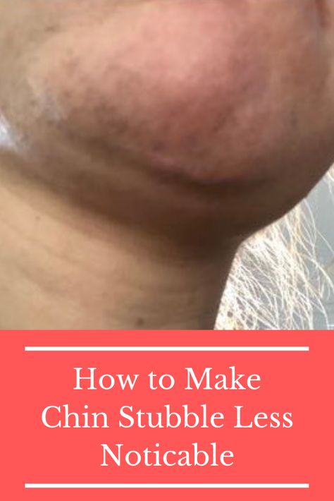 Embarrassed about the stubble on your chin? Here's what you can do to make your 5 o'clock shadow less noticeable and boost your self confidence as a woman with hirsutism! #hirsutism Get Rid Of Chin Hair Women, How To Remove Chin Hair For Women, Dark Chin Remedy, Chin Hair Removal For Women, How To Get Rid Of Chin Hair On Women, Chin Hairs On Women, Remove Chin Hair Women, How Do You Get Rid Of A Dubble Chin, How To Remove Dubble Chin