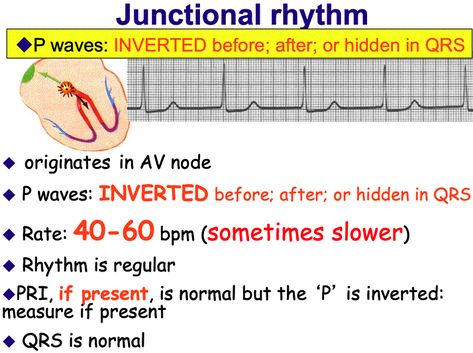 Junctional Rhythms Junctional Rhythm Ekg, Junctional Rhythm, P Wave, Nursing School Essential, Heart Rhythms, Nursing Study, Critical Care, Nclex, Cardiology