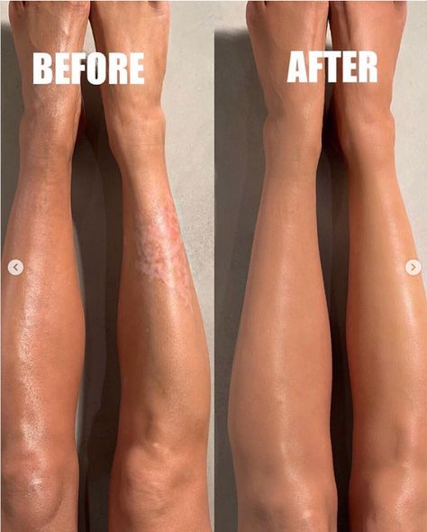 Best Body Makeup, Body Makeup For Legs Products, Leg Makeup For Veins Cover Up, Body Blur, March Photography, Leg Makeup, Varicose Vein Remedy, March Book, Kkw Beauty