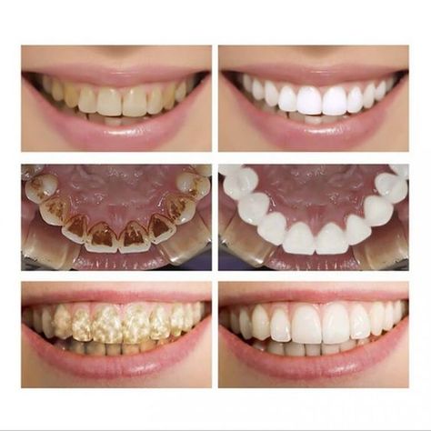 Lanbena Teeth Whitening Essence Serum Plaque Stains Remove Cleaning Liquid Oral Care Fuller Lips Naturally, Japanese Face Mask, Beauty Hacks That Actually Work, Teeth Whitening Procedure, Teeth Whitening Homemade, Teeth Whitening Diy, Teeth Whitening Toothpaste, Whitening Products, Teeth Bleaching