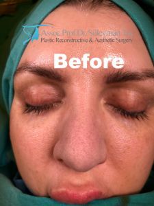 Bulbous Tip Rhinoplasty, Tip Rhinoplasty, Bulbous Nose, Crooked Nose, Small Nose, Nose Surgery, Celebrity Plastic Surgery, Thick Skin, Nose Job