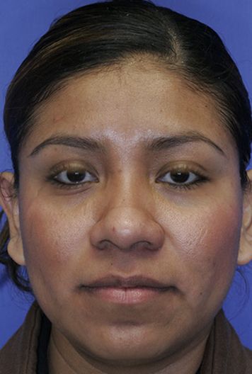 In this image, it shows this woman's wider nose and close set eyes.  If desired, and the nose is made to look more narrow, the eyes may need to be adjusted as though they are wide set eyes.  If we bring the nose in, we can bring the eyes in as well, by extending eyeliner out towards the nose, Nose Refrences Photos, Wide Nose Women, Close Set Eyes, Women References, Extreme Plastic Surgery, Reference Models, Bulbous Nose, Nose Types, Learn Yoga Poses