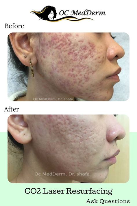 Skin Laser Before And After, Co 2 Fractional Laser, Fractional Laser Before After, Acne Laser, Fractional Laser, Laser Resurfacing, Cosmetic Dermatology, Acne Scar, Laser Skin