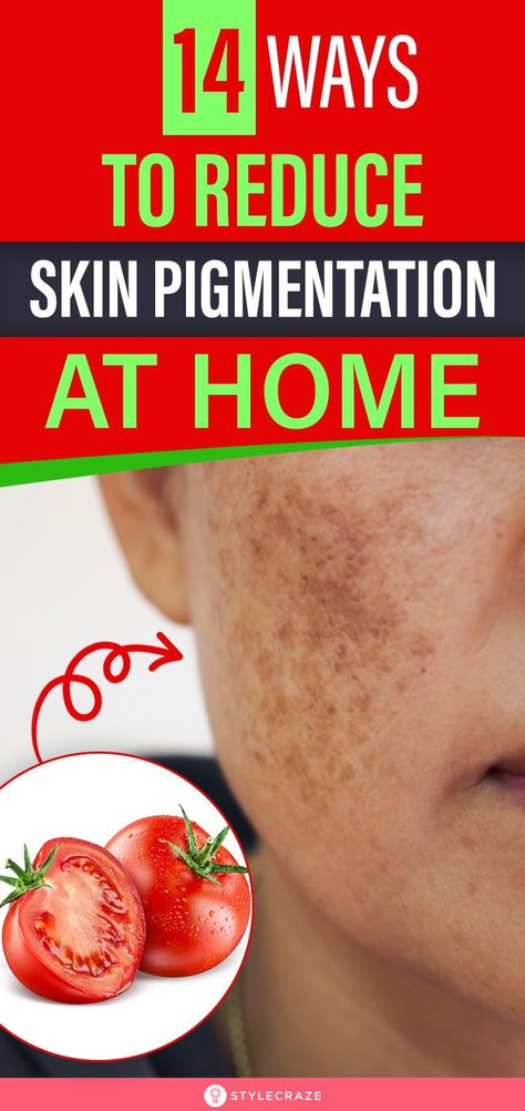 Pigmentation On Face, Hair Fall Remedies, Pigmentation Remedy, Clearing Hyperpigmentation, Beauty Skincare Aesthetic, Hyperpigmentation Remedies, Skincare Face Masks, Glowing Skin Overnight, Skincare Photoshoot