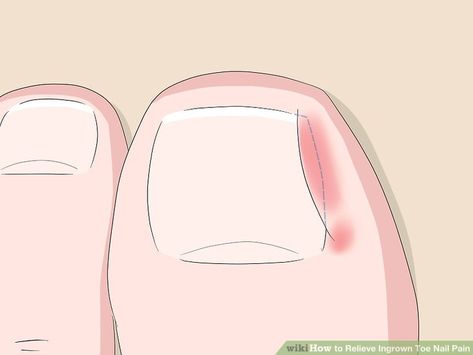 5 Ways to Relieve Ingrown Toe Nail Pain - wikiHow Toenail Pain, Toenail Removal, Ingrown Toenail, Ingrown Nail, Nail Bed, Ingrown Toe Nail, Toenail Fungus, Dental Floss, Nail Fungus