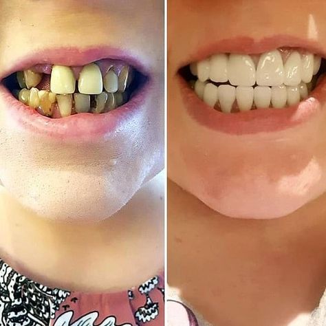 Woman shares photo of $5k teeth transformation done in Bali on Facebook Insane Smile, Teeth Transformation, How To Use Foundation, Smile Tips, Beauty Blender How To Use, Beauty Room Vanity, Teeth Dentist, Crockpot Spaghetti And Meatballs, Cat Exercise