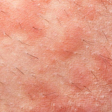 Eczema Types Of Skin Rashes, Common Skin Rashes, Types Of Rashes, Treating Cystic Acne, Itchy Rash, Home Remedies For Skin, Flaking Skin, Cystic Acne, Skin Pores