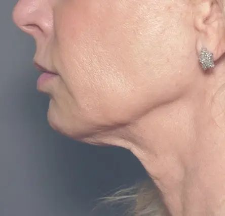 How To Tighten Sagging Jowls - Doctor Nyla Medispa Sagging Jowls, Facial Veins, Laser Skin Tightening, Sagging Neck, Nose Reshaping, Laser Skin Resurfacing, Oxygen Facial, Anti Wrinkle Treatments, Cosmetic Clinic