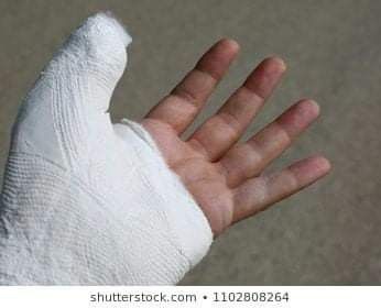 Hand Plaster Fracture, Fracture Photo, Hand Fracture, Mp3 Download App, Plaster Hands, Broken Finger, Photoshop Hair, Arm Cast, Hand Finger