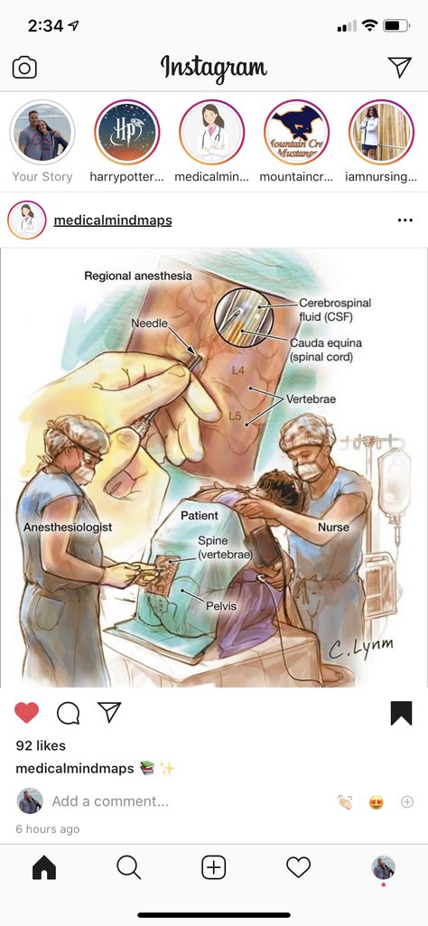 Spinal Anesthesia, Cauda Equina, Spinal Cord, Your Story, Quick Saves