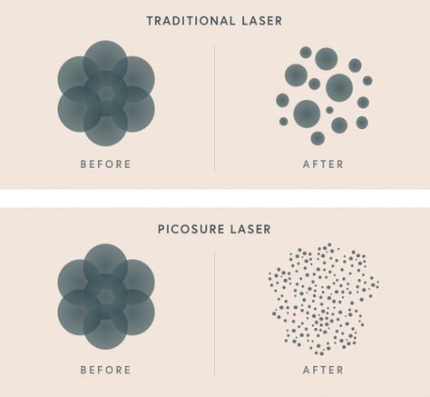 How can PicoSure achieve better clearance with fewer treatments?  https://www.andreacatton.co.uk/treatments/picosure-tattoo-removal/ Coolpeel Laser, Erbium Laser Resurfacing, Fotona 4d Laser Before After, Picosure Tattoo Removal, Cosmetic Laser Skin Treatments, Kenzzi Ipl Laser Hair Removal Handset, Laser Skin, Tattoo Removal, Canning