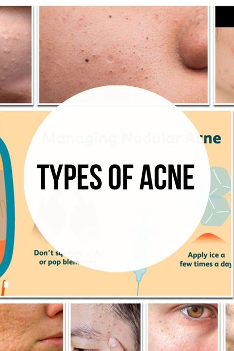 Types Of Acne On Face Explained Pimple Types, Pustules Acne, Nodular Acne, Different Types Of Acne, Pimples On Face, Types Of Acne, Acne Causes, Skin Diseases, Skin Care Acne